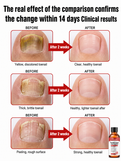 【Painless Nail Replacement】Herbal mild liquid to repair fungal nails